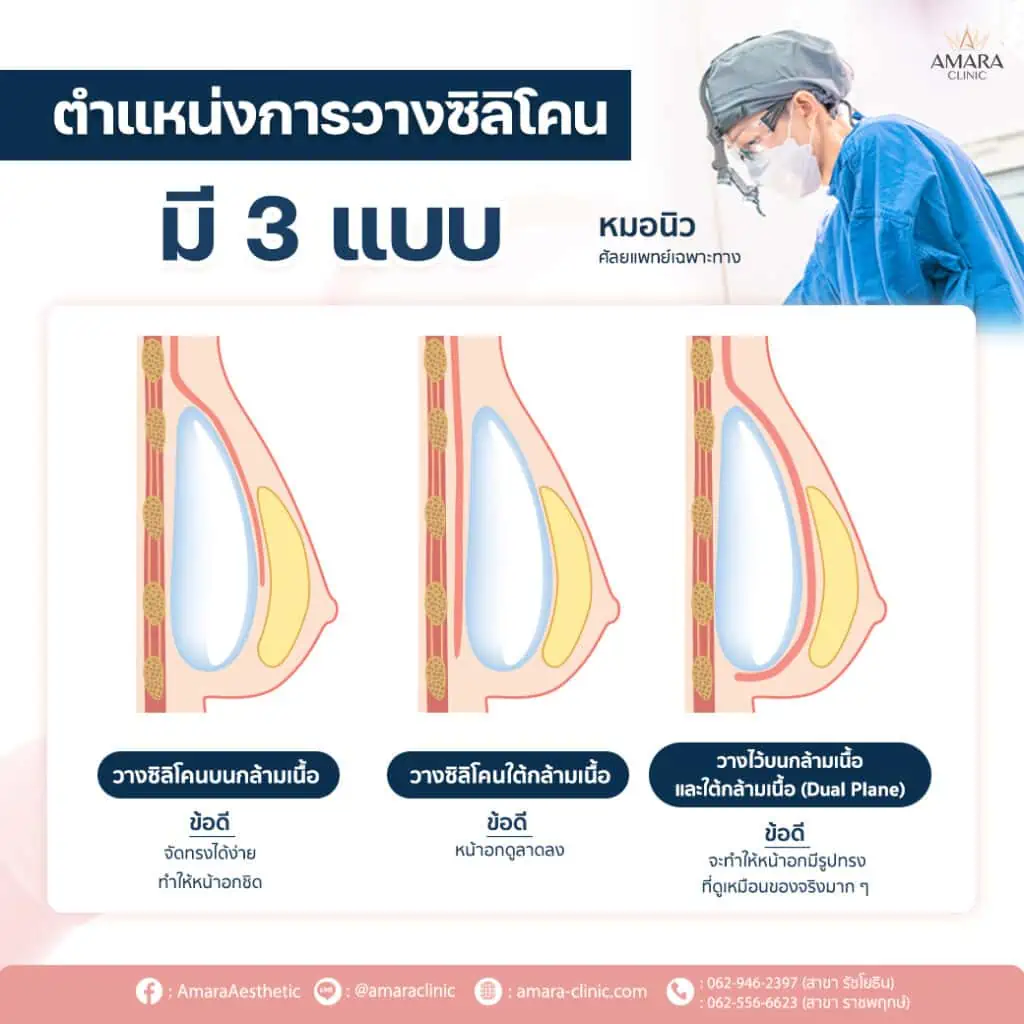 ทำนม มีกี่แบบ breast augmentation