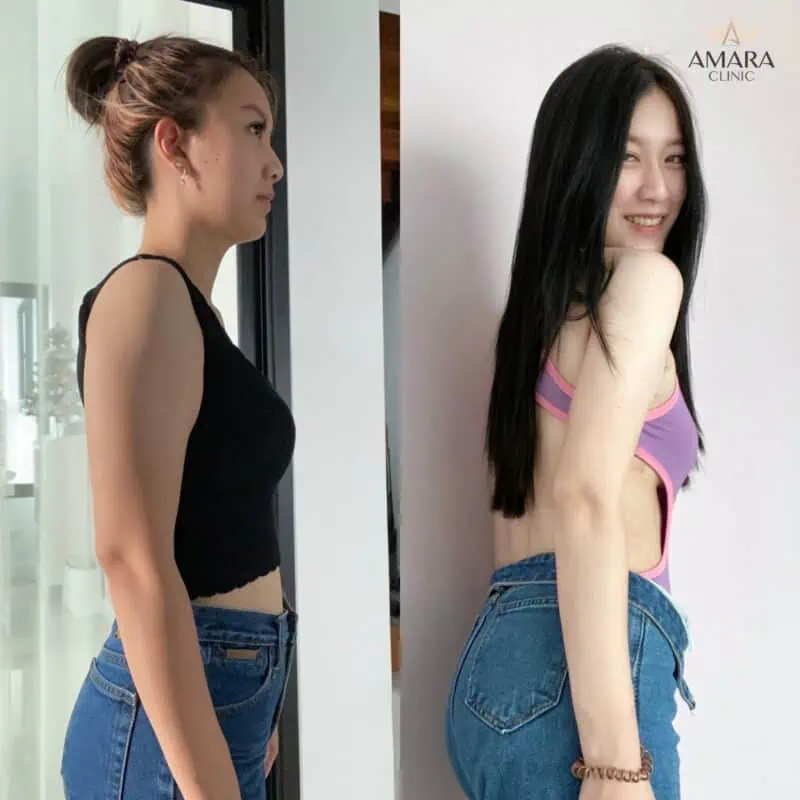 ดูดไขมันต้นแขน amara clinic