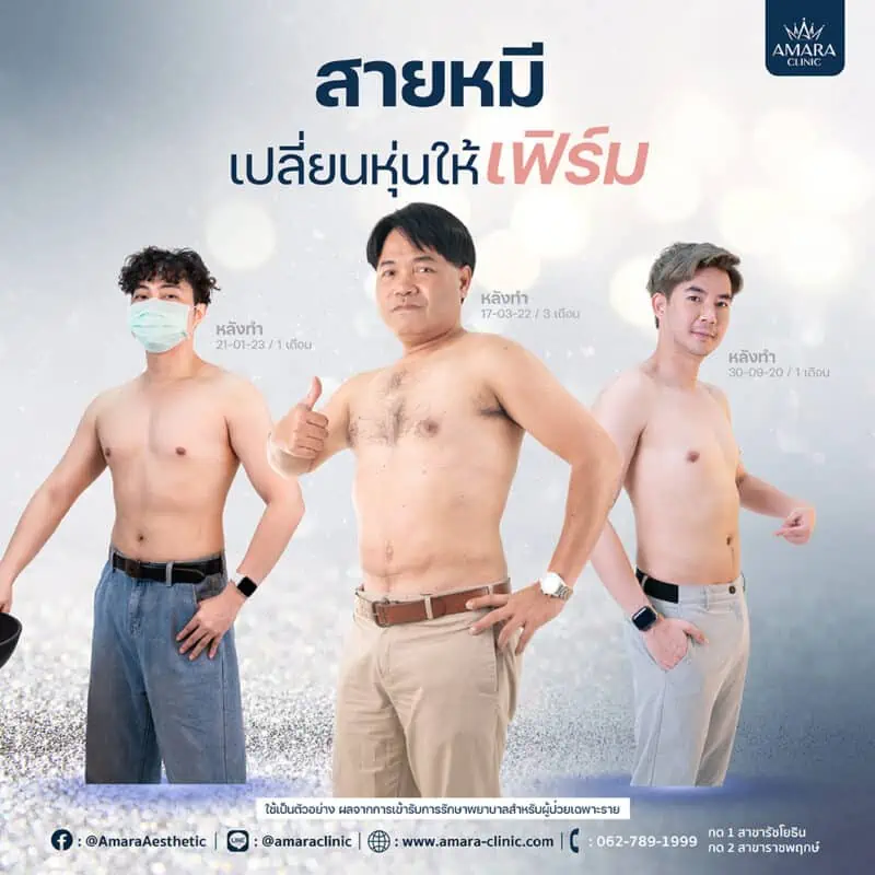 ดูดไขมันผู้ชาย