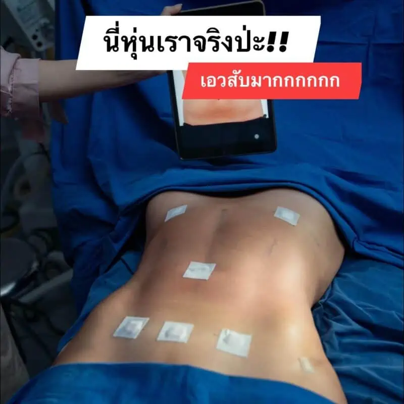 รีวิว ดูดไขมัน