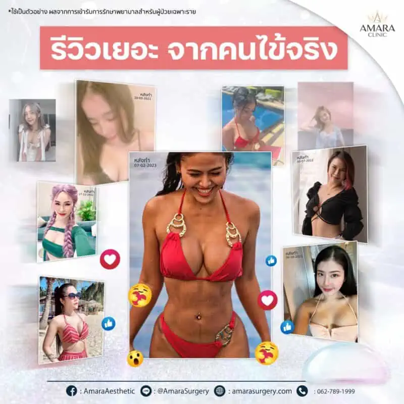 เสริมหน้าอก ราคา - รีวิว ทำนม