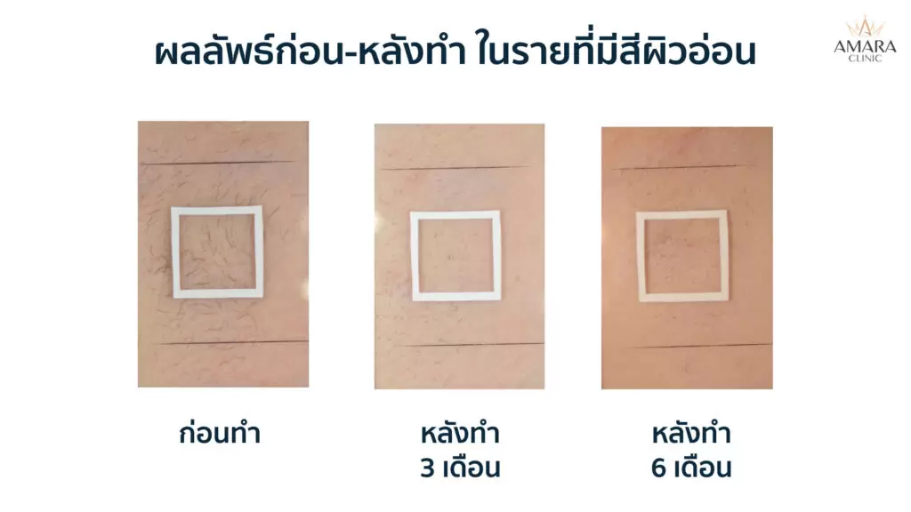 เลเซอร์กำจัดขน - amara skin center