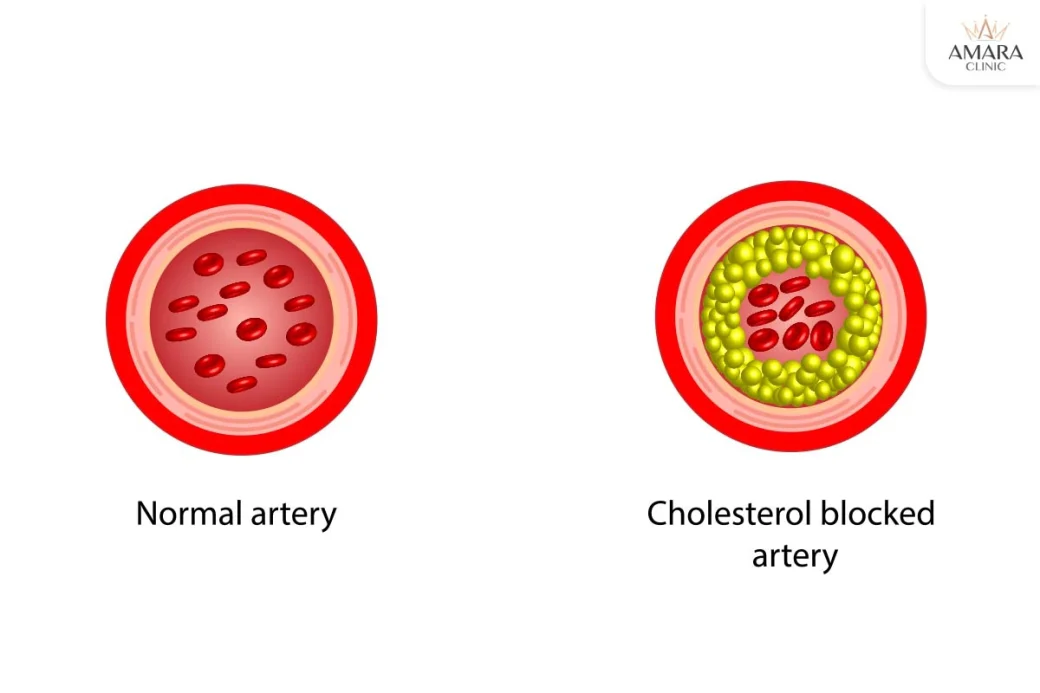 Effects of high LDL level