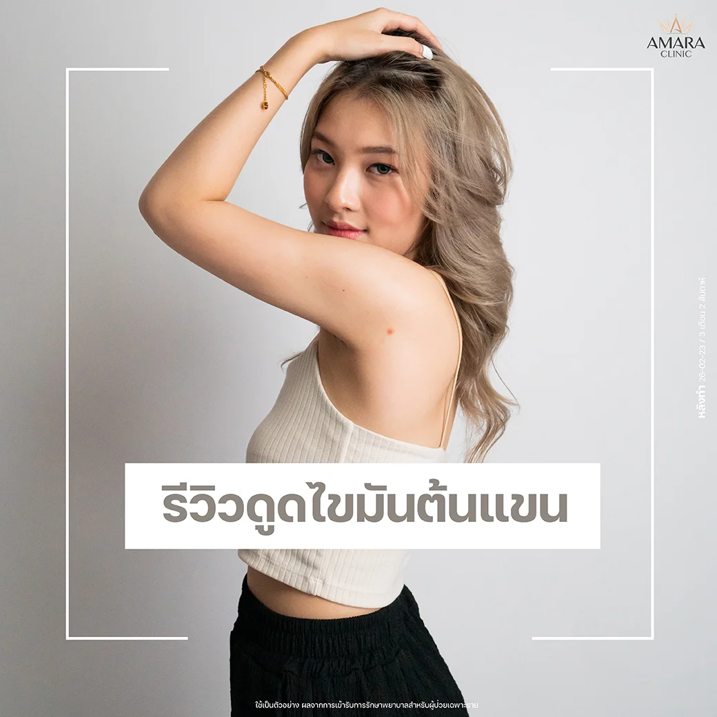 รีวิว ดูดไขมันต้นแขน