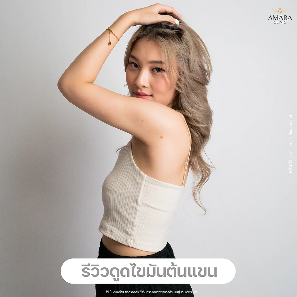 รีวิว ดูดไขมันต้นแขน