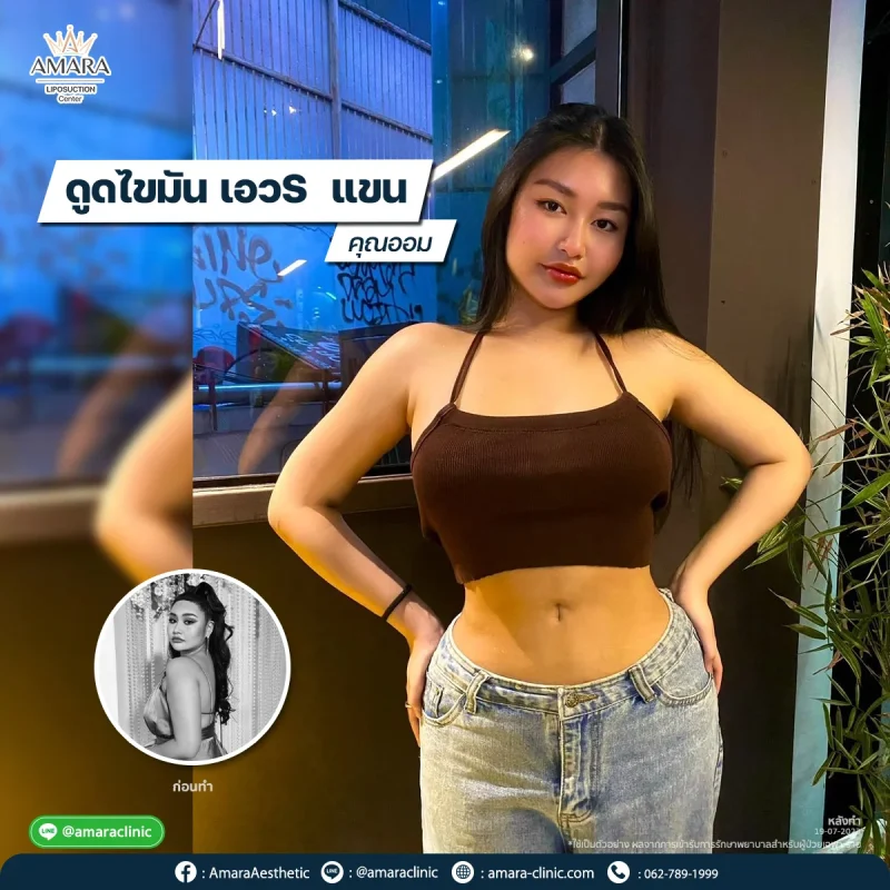 amara clinic รีวิว ดูดไขมัน