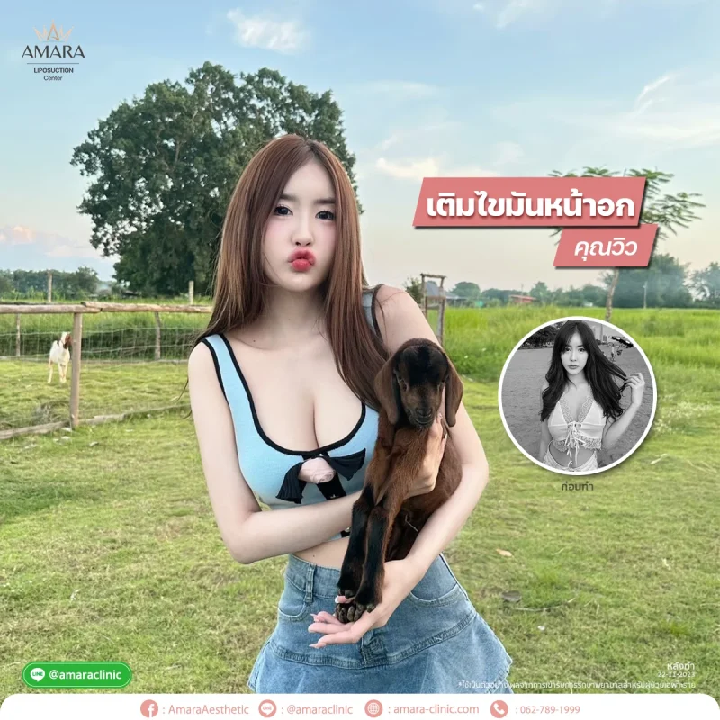 รีวิวฉีดไขมันหน้าอก