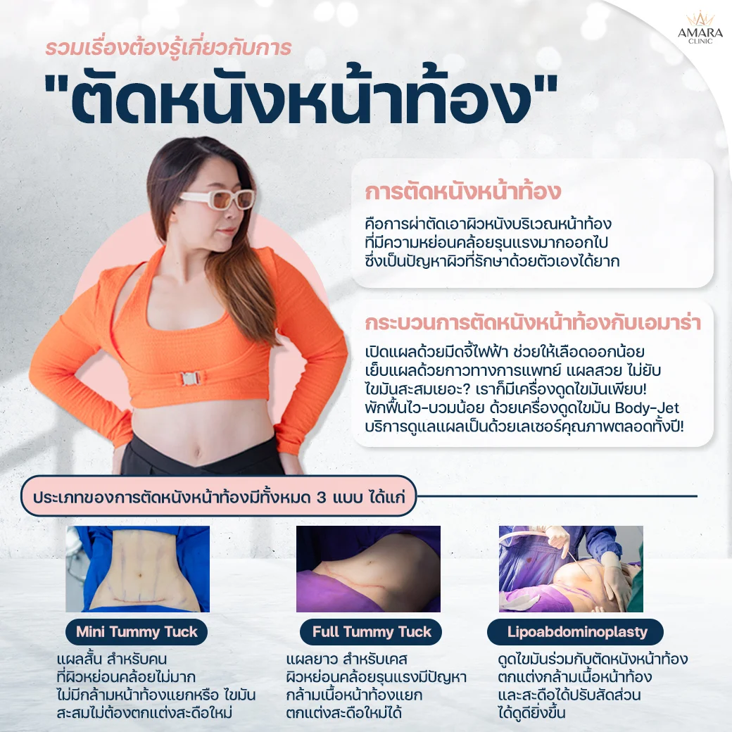 Tummy tuck information