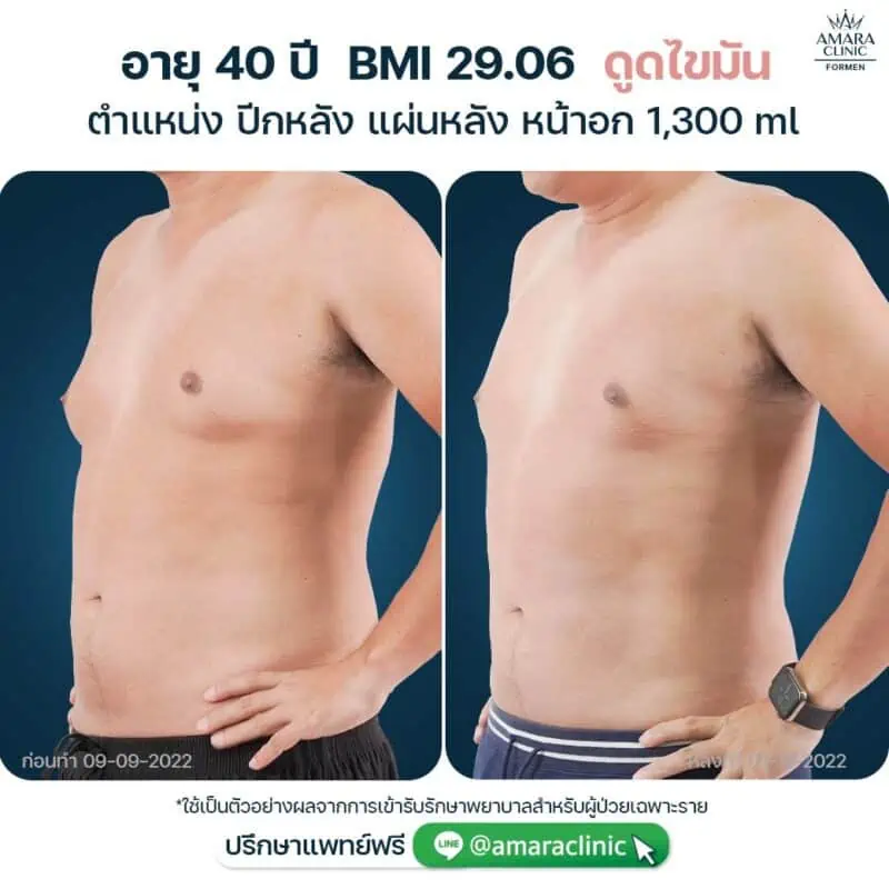 ดูดไขมันชาย - liposuction for men