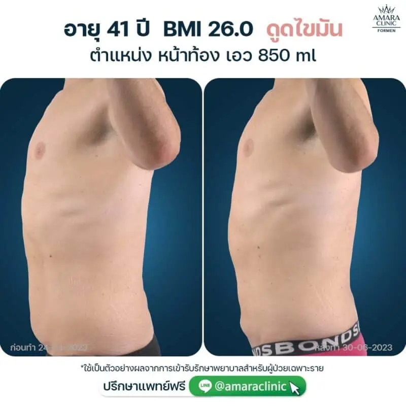 liposuction mens belly