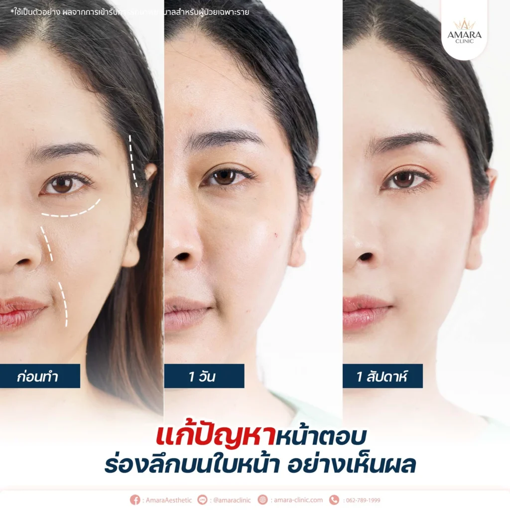 ฉีดไขมันหน้า - Amara