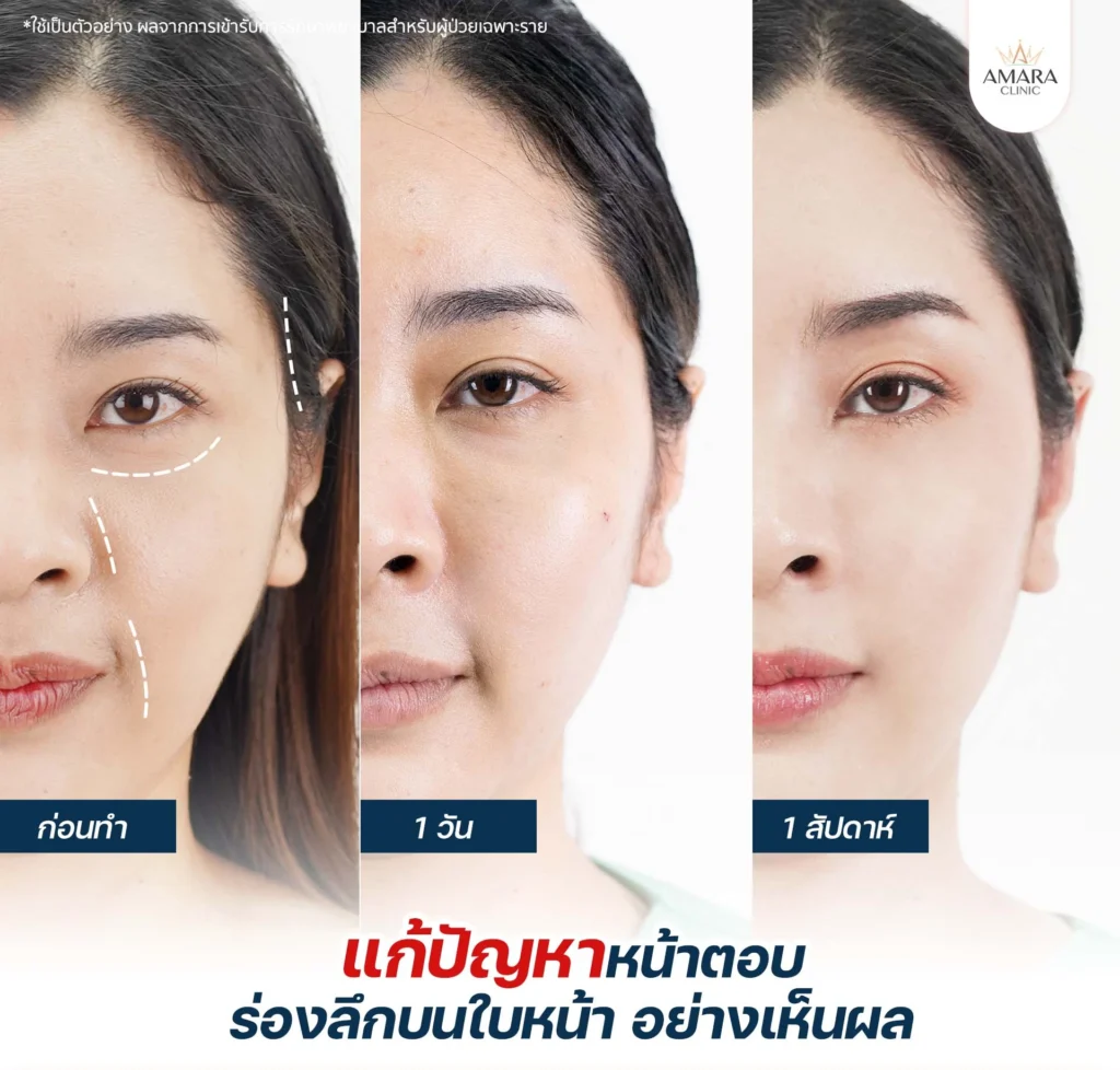 ฉีดไขมันหน้า - Amara