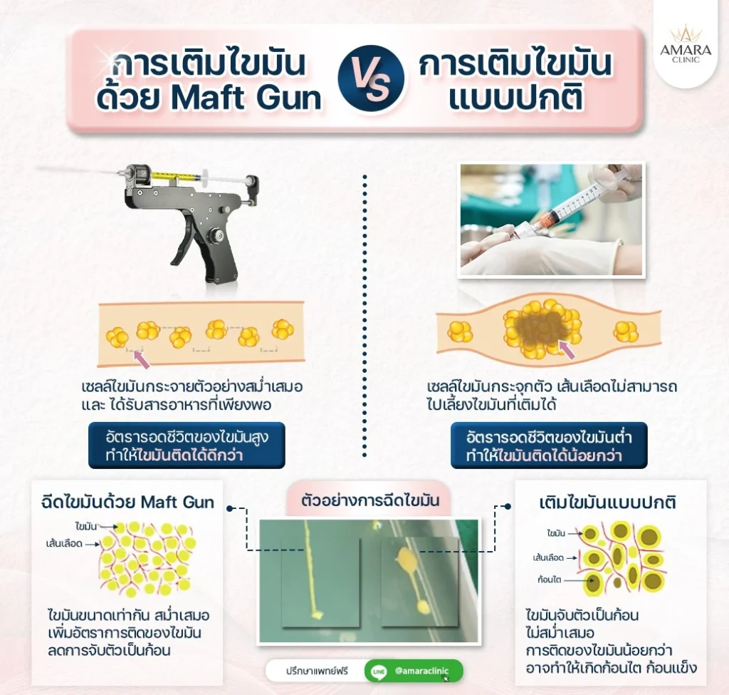 ขั้นตอนการเติมไขมัน Maftgun-VS-การเติมไขมันแบบปกติ