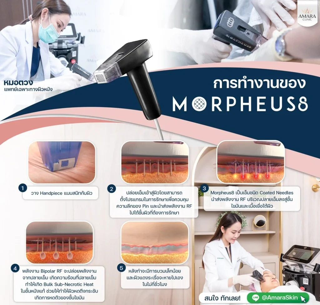 การทำงานของ Morpheus8 (มอเฟียส)