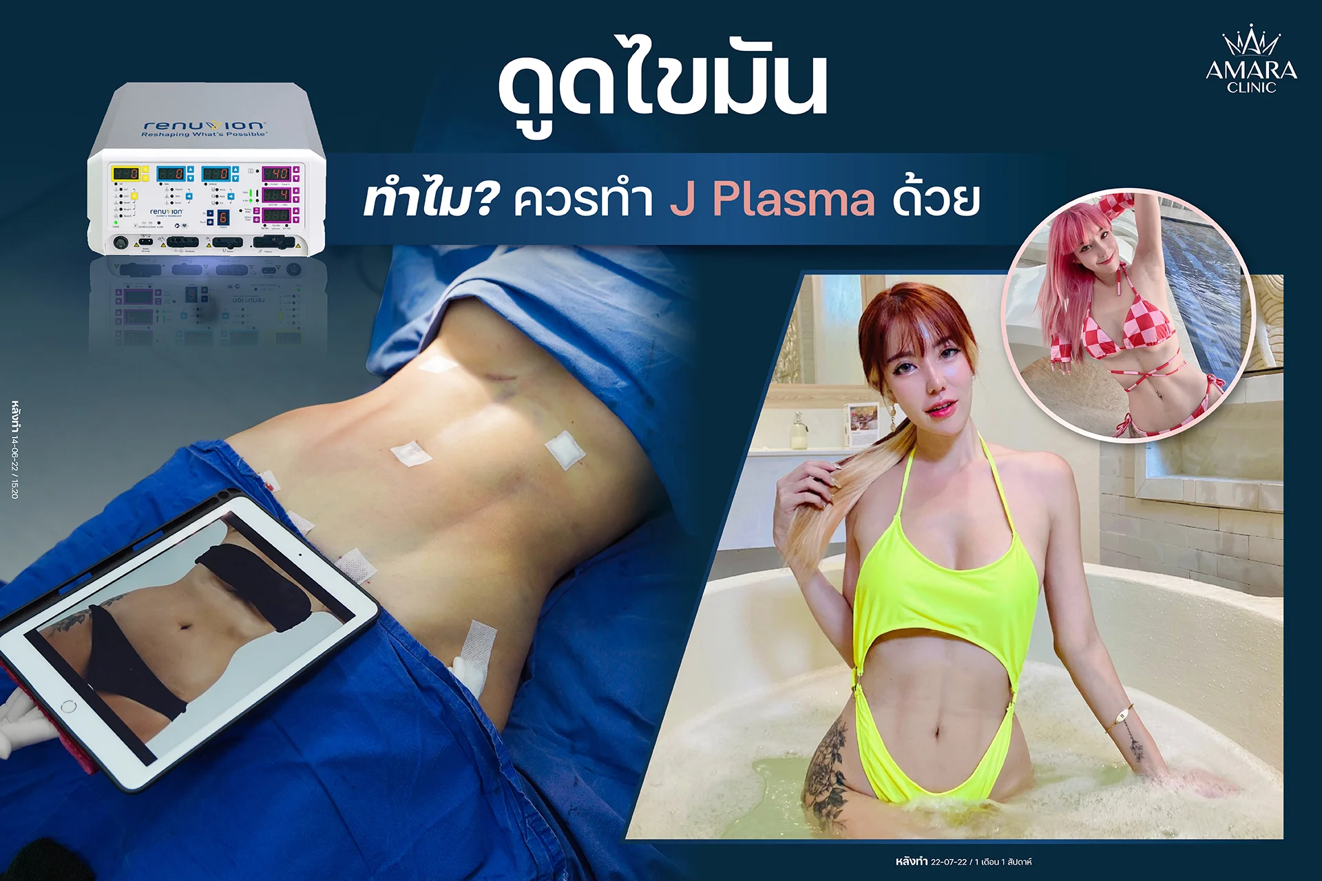 ดูดไขมัน j plasma