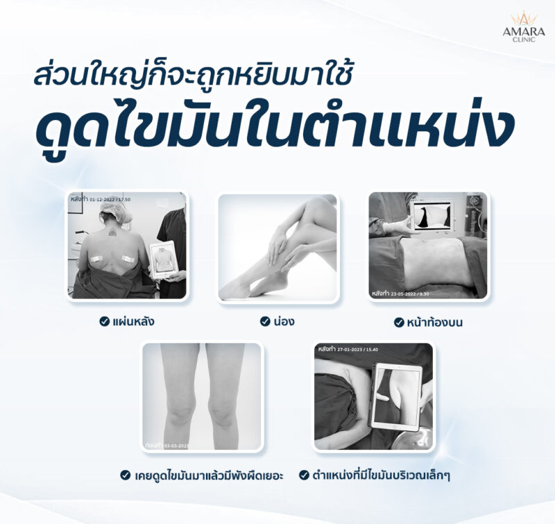 ตำแหน่งดูดไขมัน MicroAire-PAL