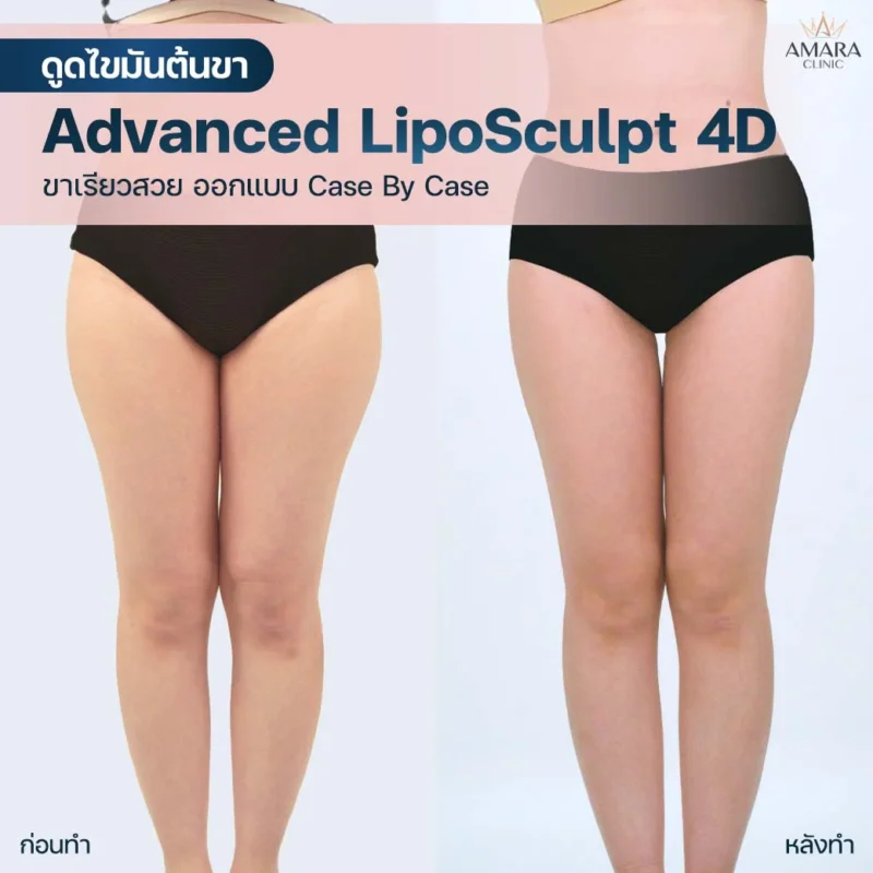 ดูดไขมันต้นขา Thigh Liposuction Before/After