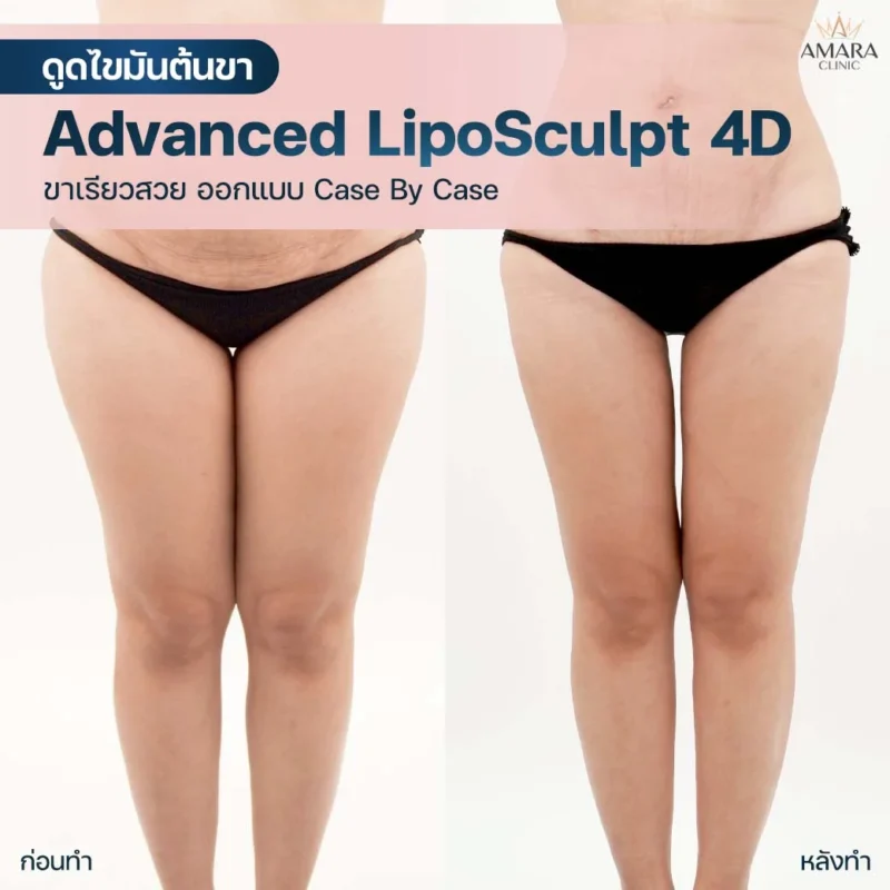 ดูดไขมันต้นขา Thigh Liposuction Before/After