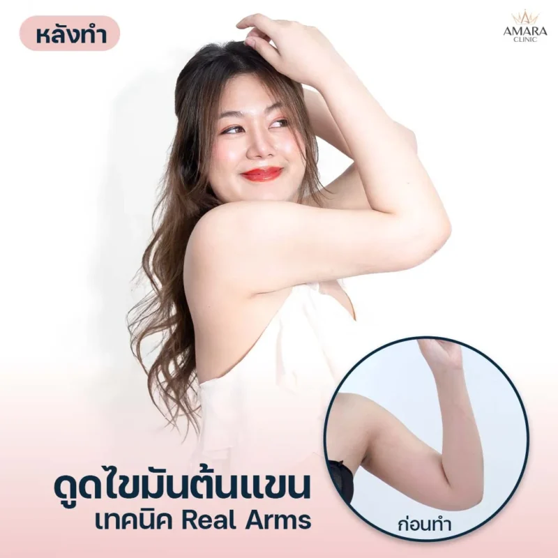 ดูดไขมันต้นแขน AMARA เทคนิค Real Arms