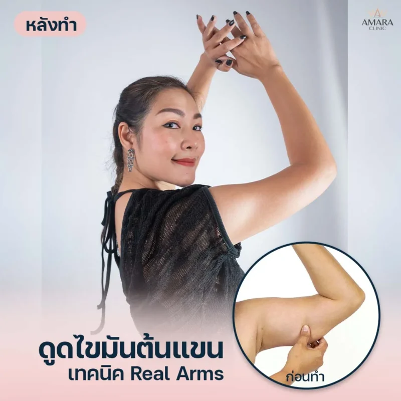 ดูดไขมันต้นแขน AMARA เทคนิค Real Arms