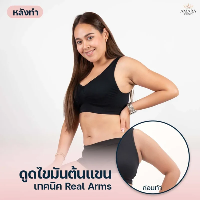 ดูดไขมันต้นแขน AMARA เทคนิค Real Arms