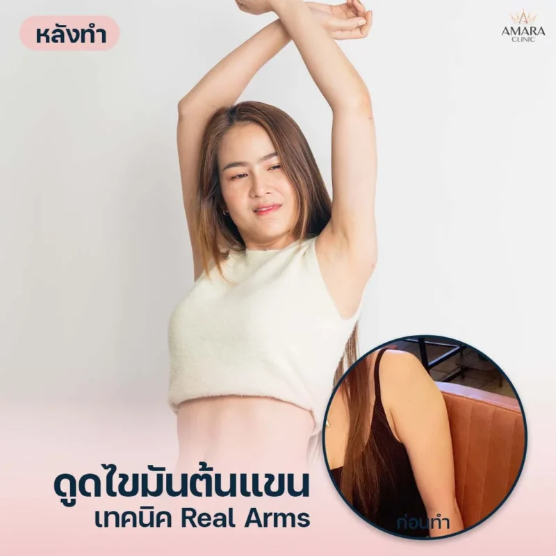 ดูดไขมันต้นแขน AMARA เทคนิค Real Arms