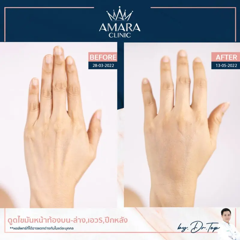 ฉีดไขมันมือ