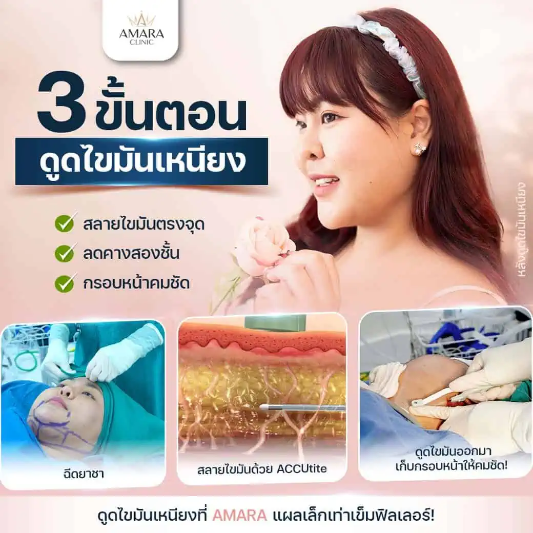 ขั้นตอนดูดไขมันเหนียง 3 วิธี