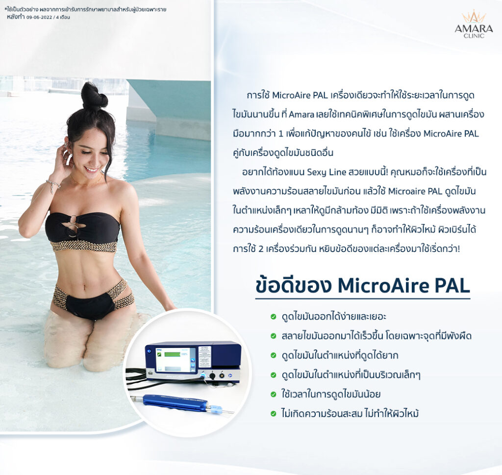 ข้อดี MicroAire-PAL