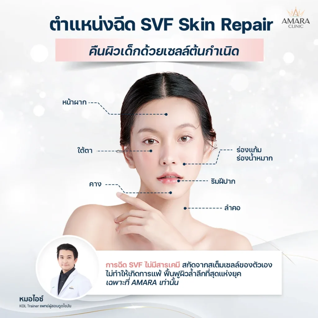 ตำแหน่งฉีดหน้าใส SVF Skin Repair