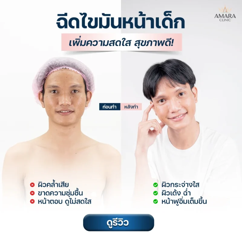 ฉีดไขมันหน้า ผู้ชาย