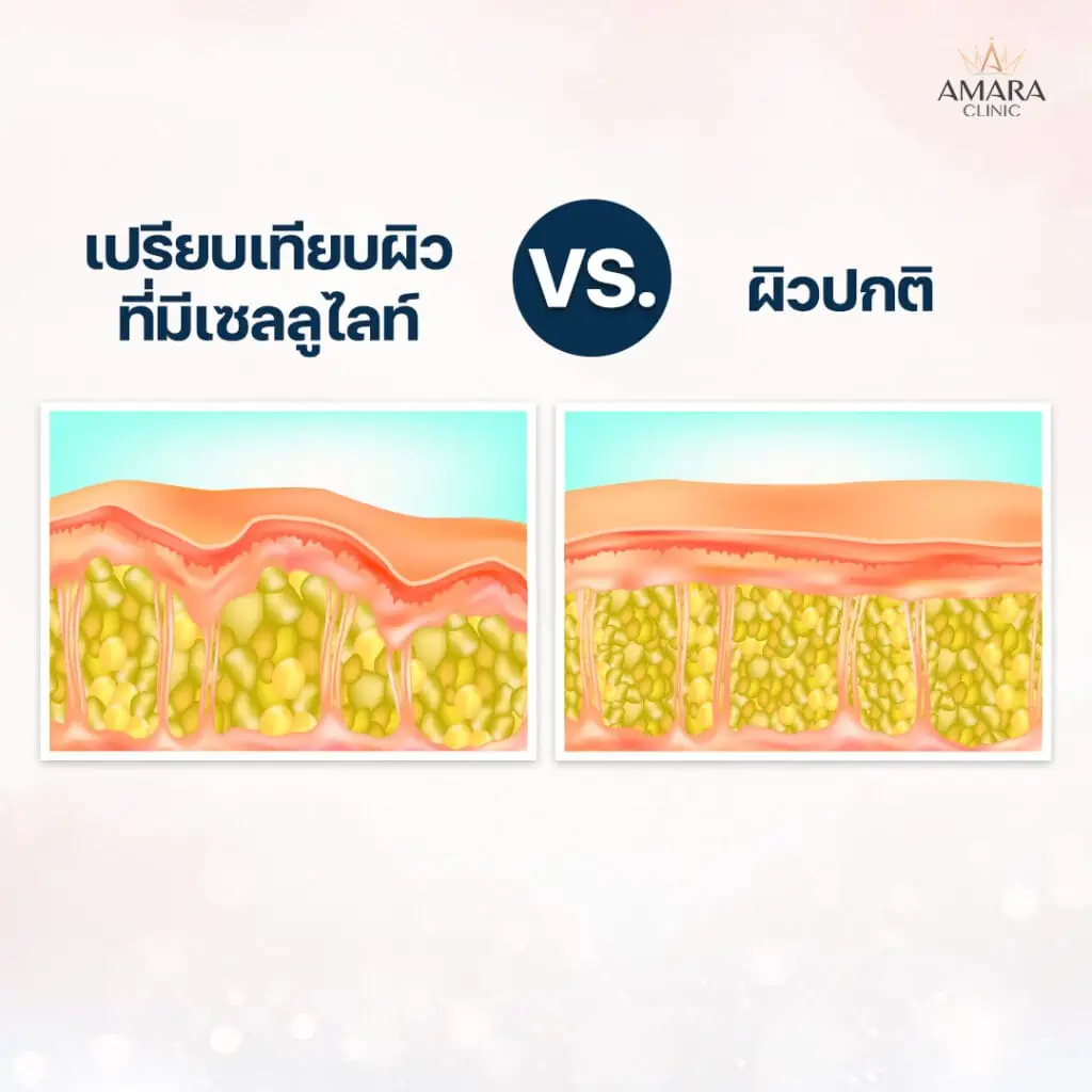 thighs-cellulite-reducing  เซลลูไลท์ต้นขา เกิดจาก