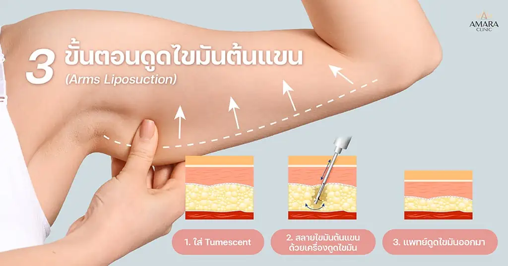 ขั้นตอนการดูดไขมันลดต้นแขน