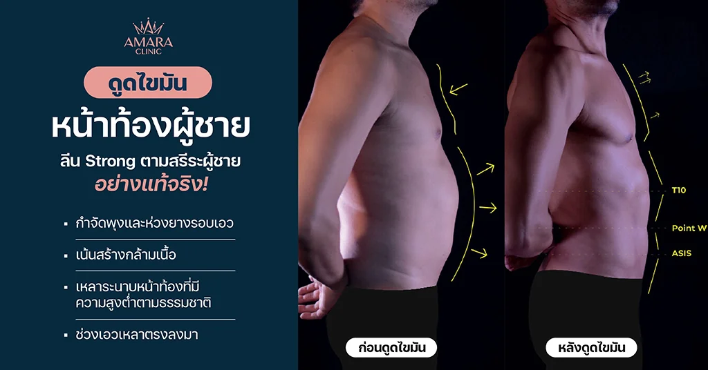 ดูดไขมันหน้าท้องผู้ชาย เทคนิค Advanced LipoSculpt 4D