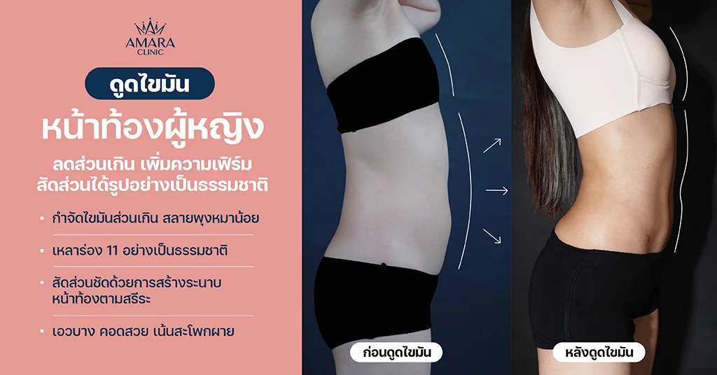 ดูดไขมันหน้าท้อง ผู้หญิง เทคนิค Advanced LipoSculpt 4D