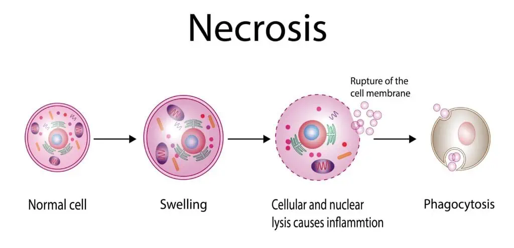 ภาวะเซลล์ตาย Necrosis