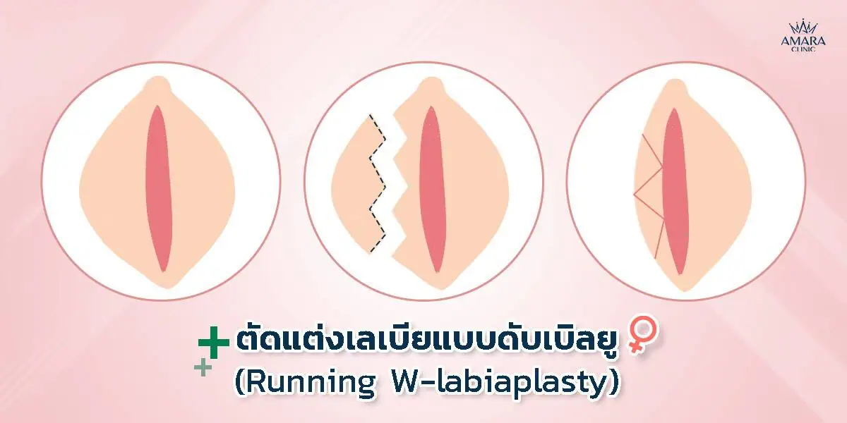 การตัดเลเบียแบบดับเบิลยู (Running W)