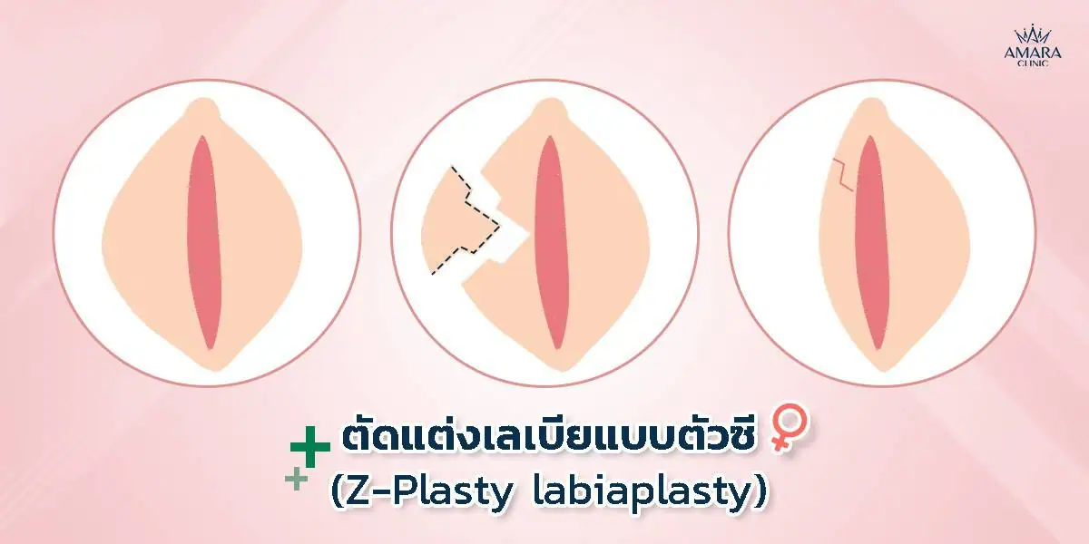 การตัดเลเบียแบบตัวซี (Z-Plasty)