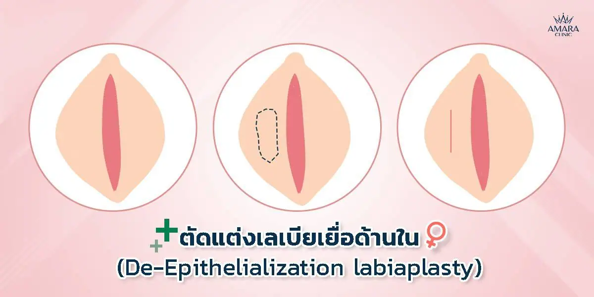  การตัดเลเบียเยื่อด้านใน (De-Epithelialization)