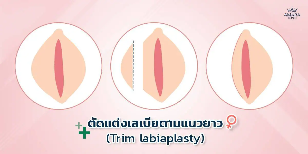  การตัดเลเบียแบบตามแนวยาว (Trim)