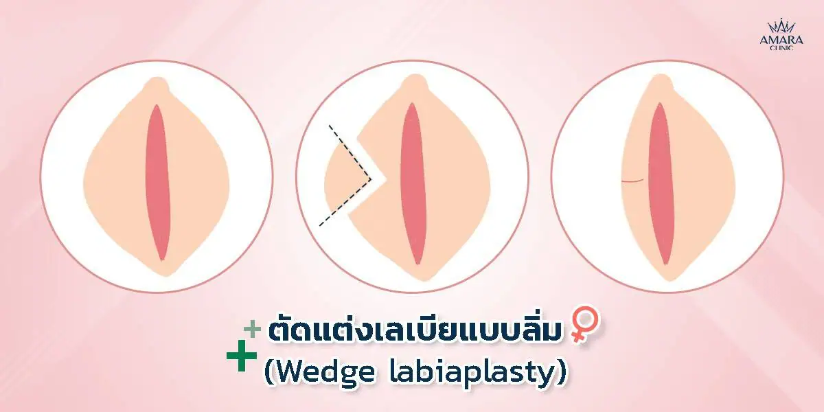  การตัดเลเบียแบบลิ่ม (Wedge)