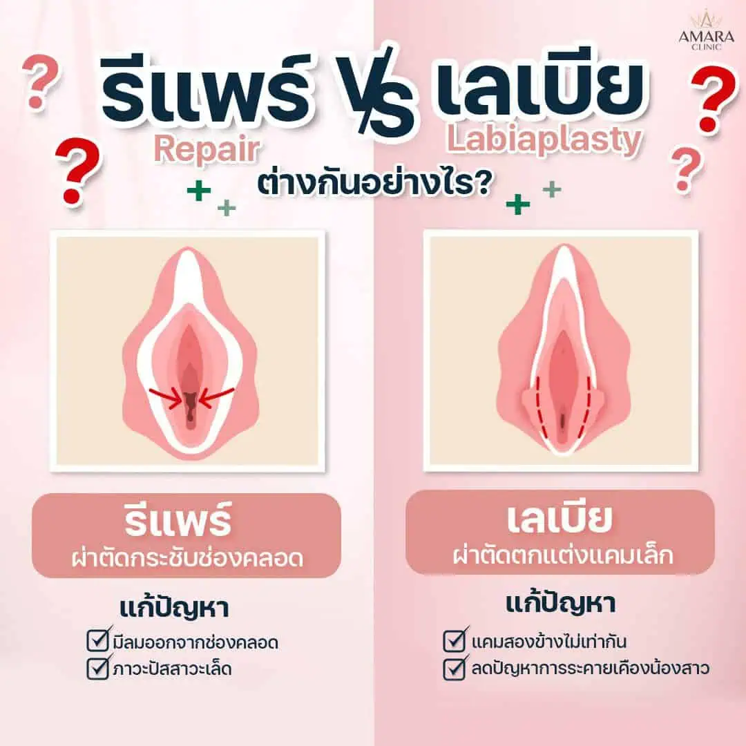 ความแตกต่างระหว่างรีแพร์กับเลเบีย