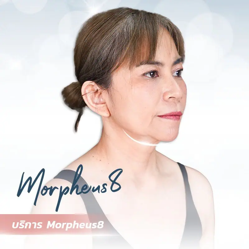 morpheus8