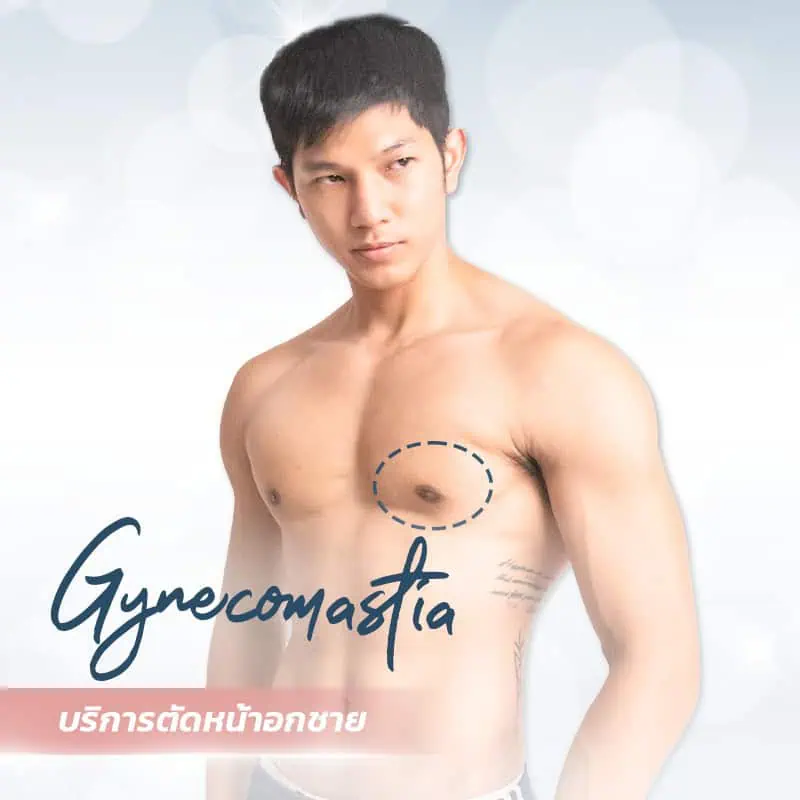 gynecomastia