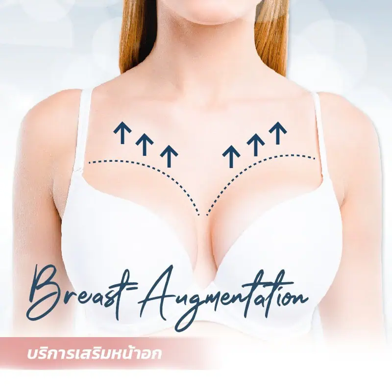 breast augmentation