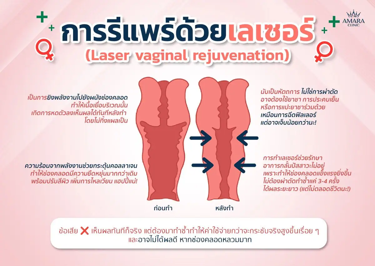 การรีแพร์ด้วยการเลเซอร์ช่องคลอด