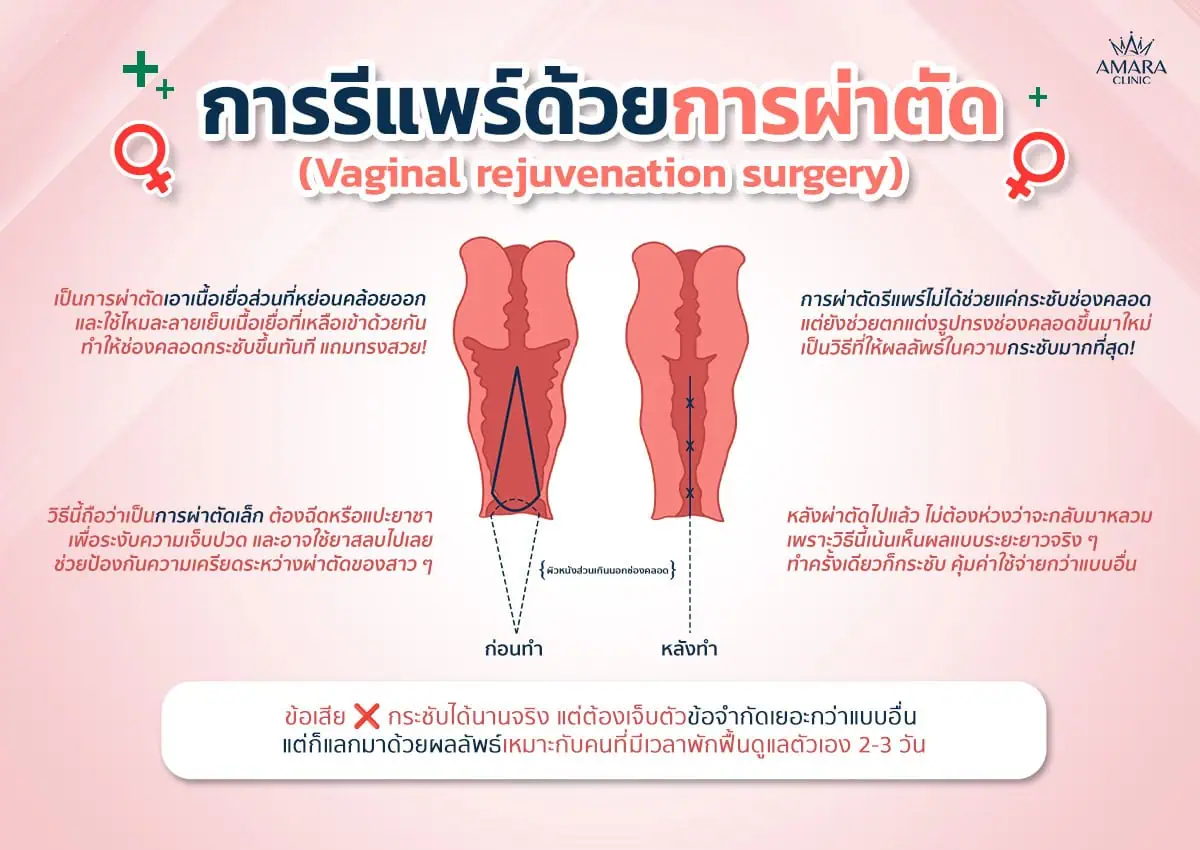  การรีแพร์ด้วยการเลเซอร์ช่องคลอด