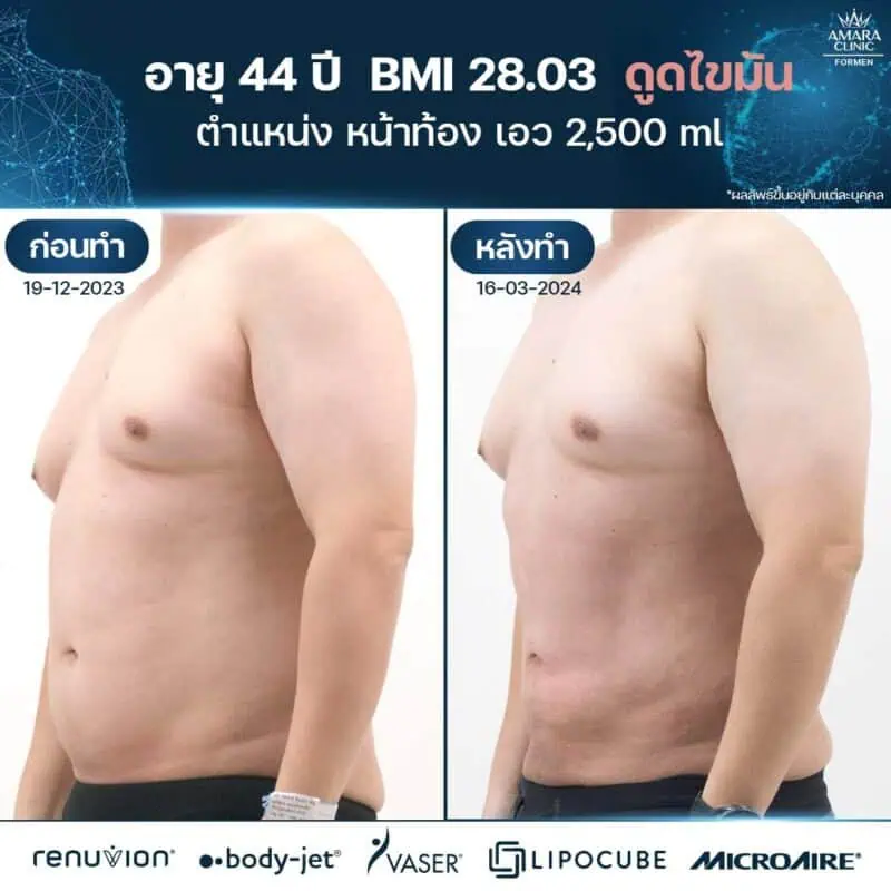 liposuction in Bangkok