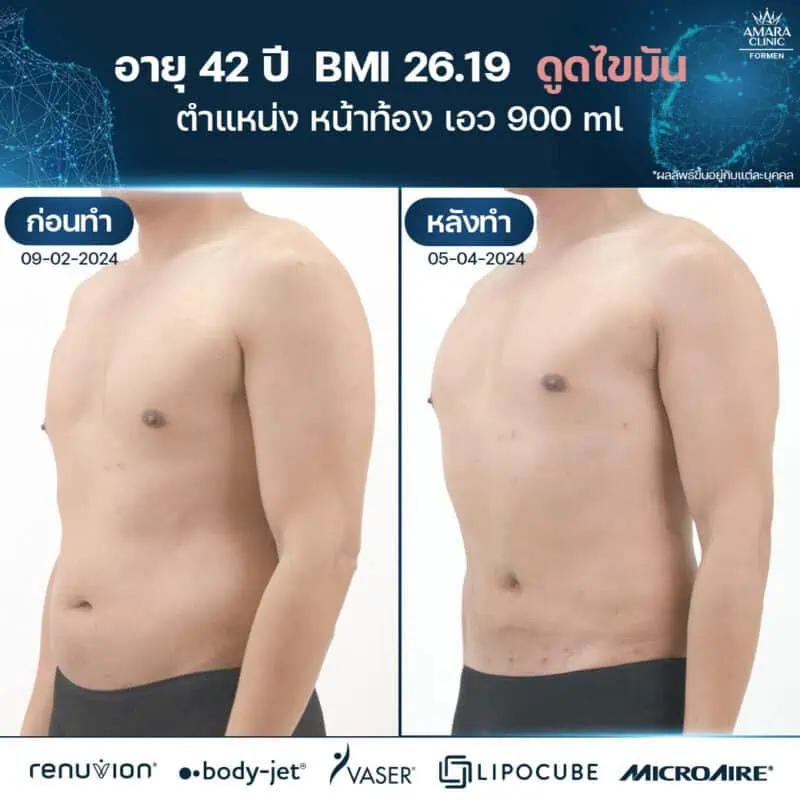 Vaser liposuction in Bangkok