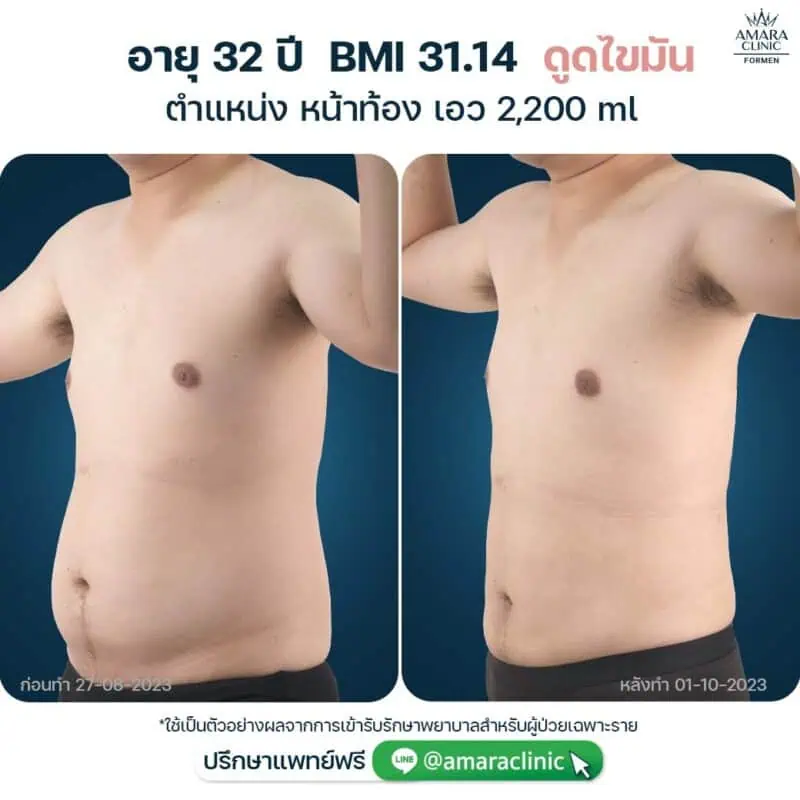 liposuction mens belly